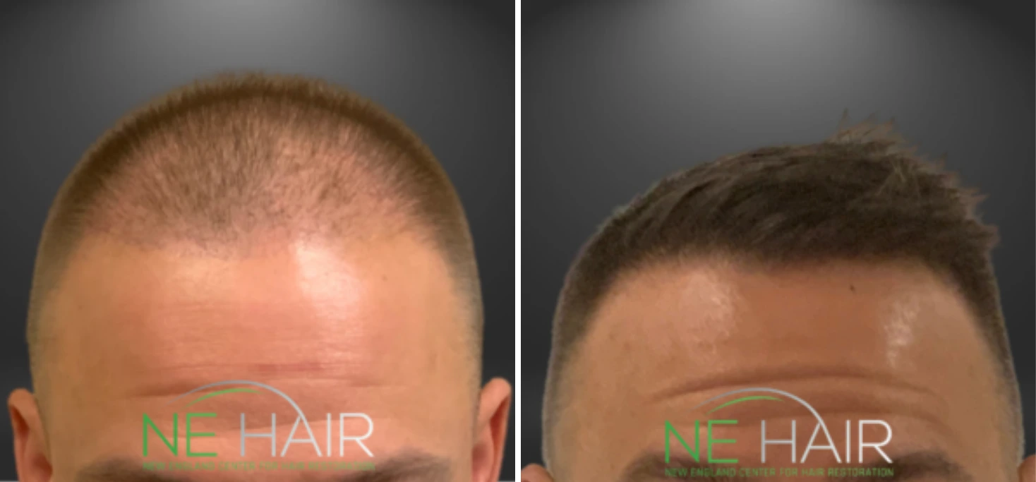 Before and after view of patient's head showing hair growth across bald crown area