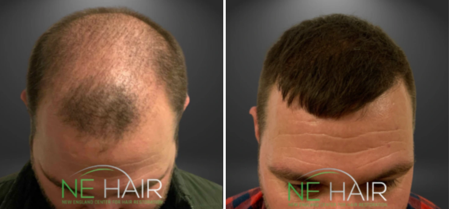 Before and after view of patient's head showing hair restoration on bald spot and hairline