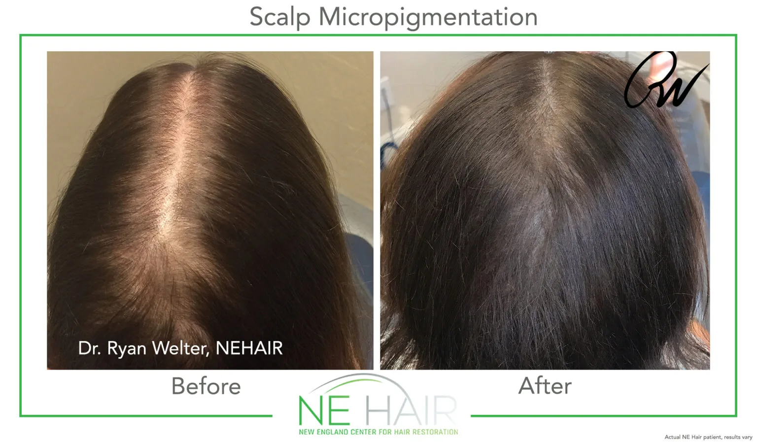 Scalp micropigmentation before and after in Boston, MA: thinning crown and part line before, fuller-looking density after, treated by Dr. Ryan Welter