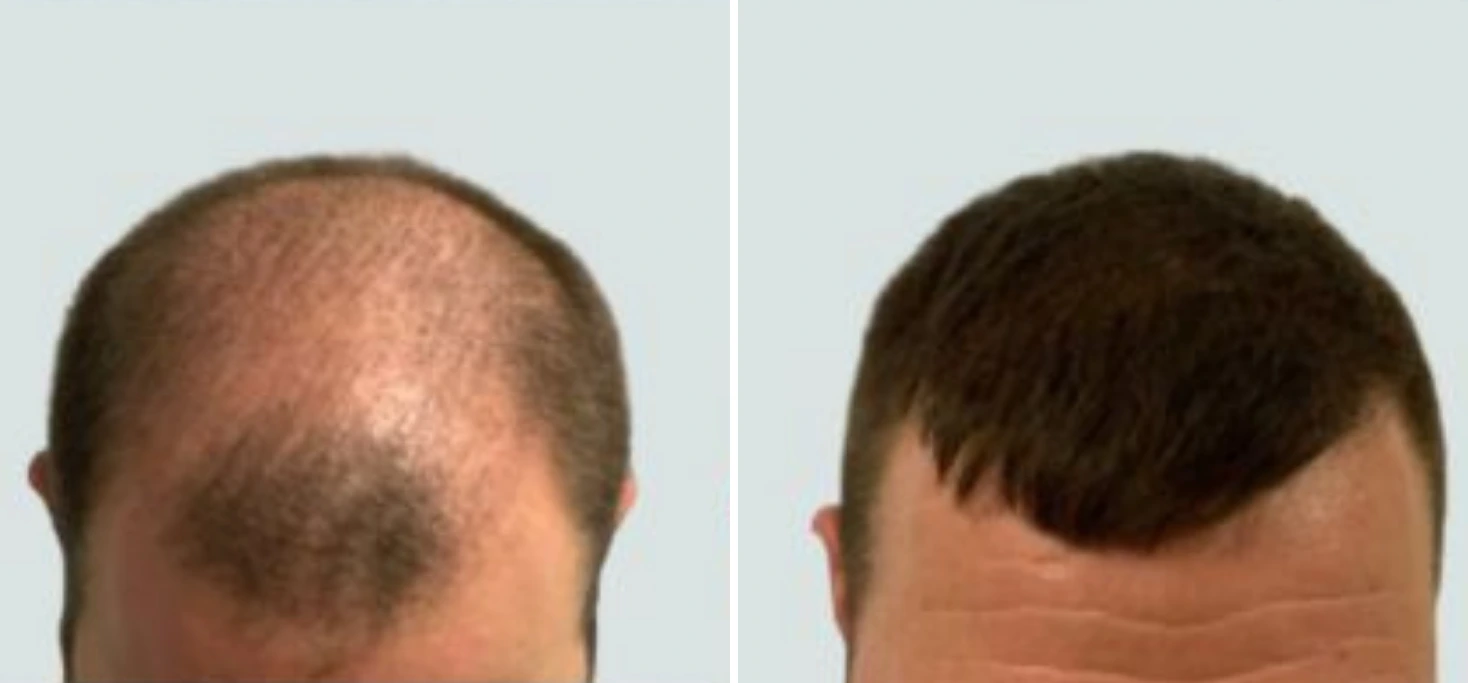 Hair Transplant Before & After Case 54 Banner