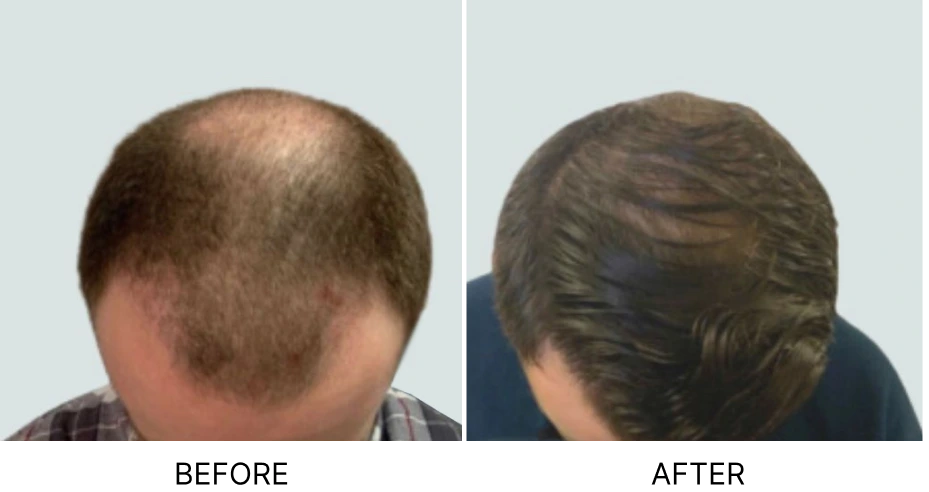 Long Hair FUE Before & After