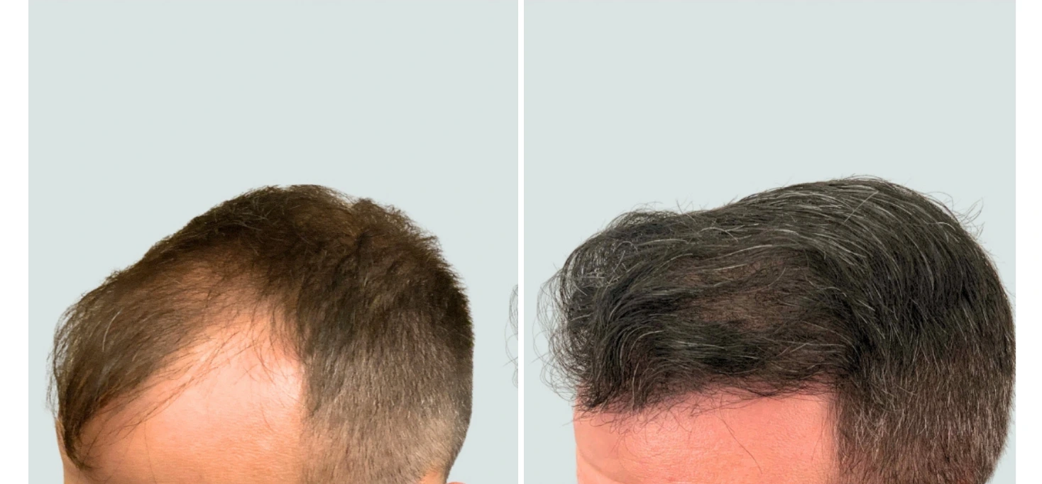 Before and after comparison of hair restoration on back of head, showing sparse hair progressing to thicker hair growth