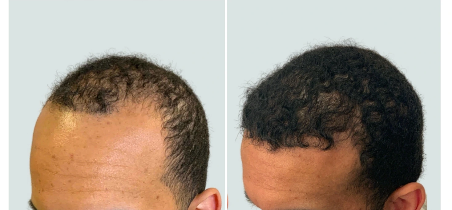 Before and after hair restoration: thinning hair on crown before treatment, fuller hair coverage after Regeneris treatment