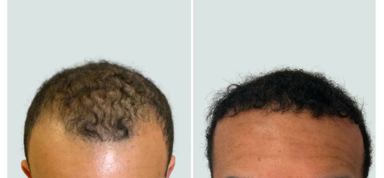 Before and after hair restoration: sparse hair on crown before treatment, full hairline after Regeneris treatment