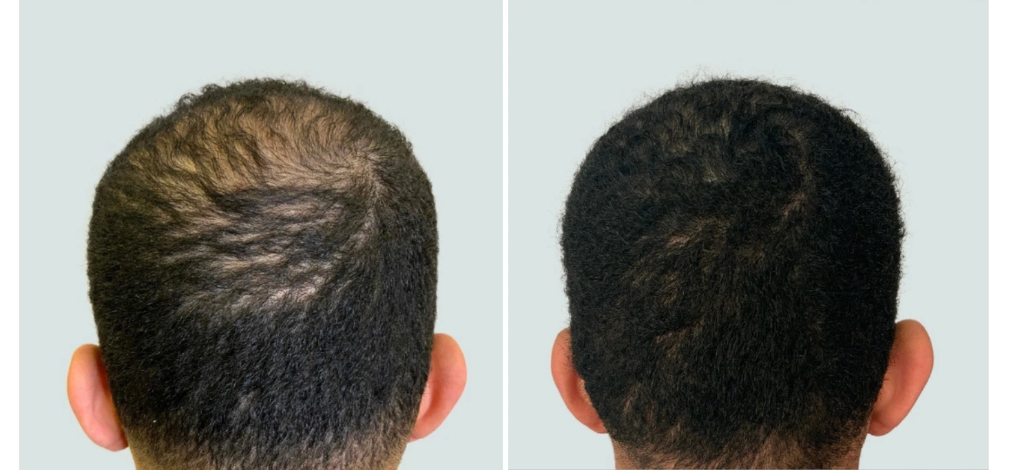 Before and after comparison of hair restoration on back of head, showing thinning hair progressing to restored fullness