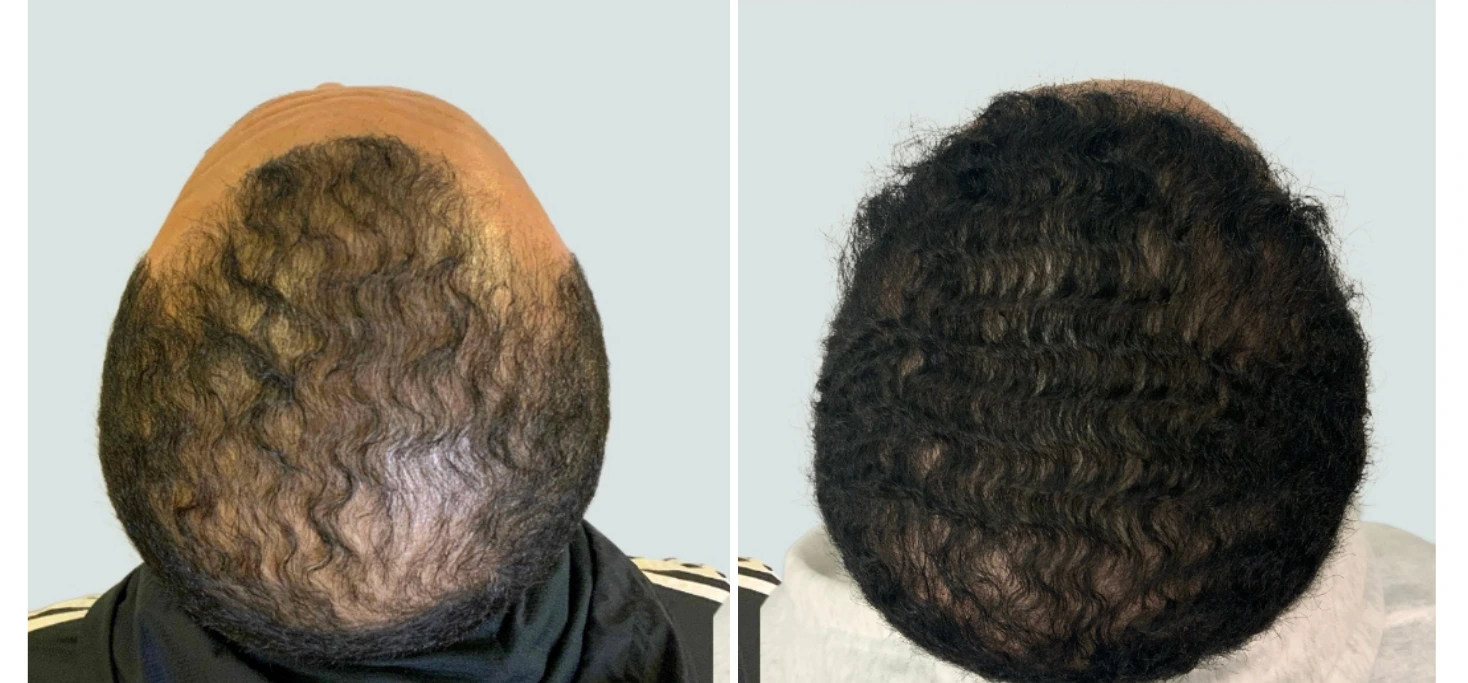 Before and after comparison of hair restoration on crown, showing significant hair loss improving to fuller hair density