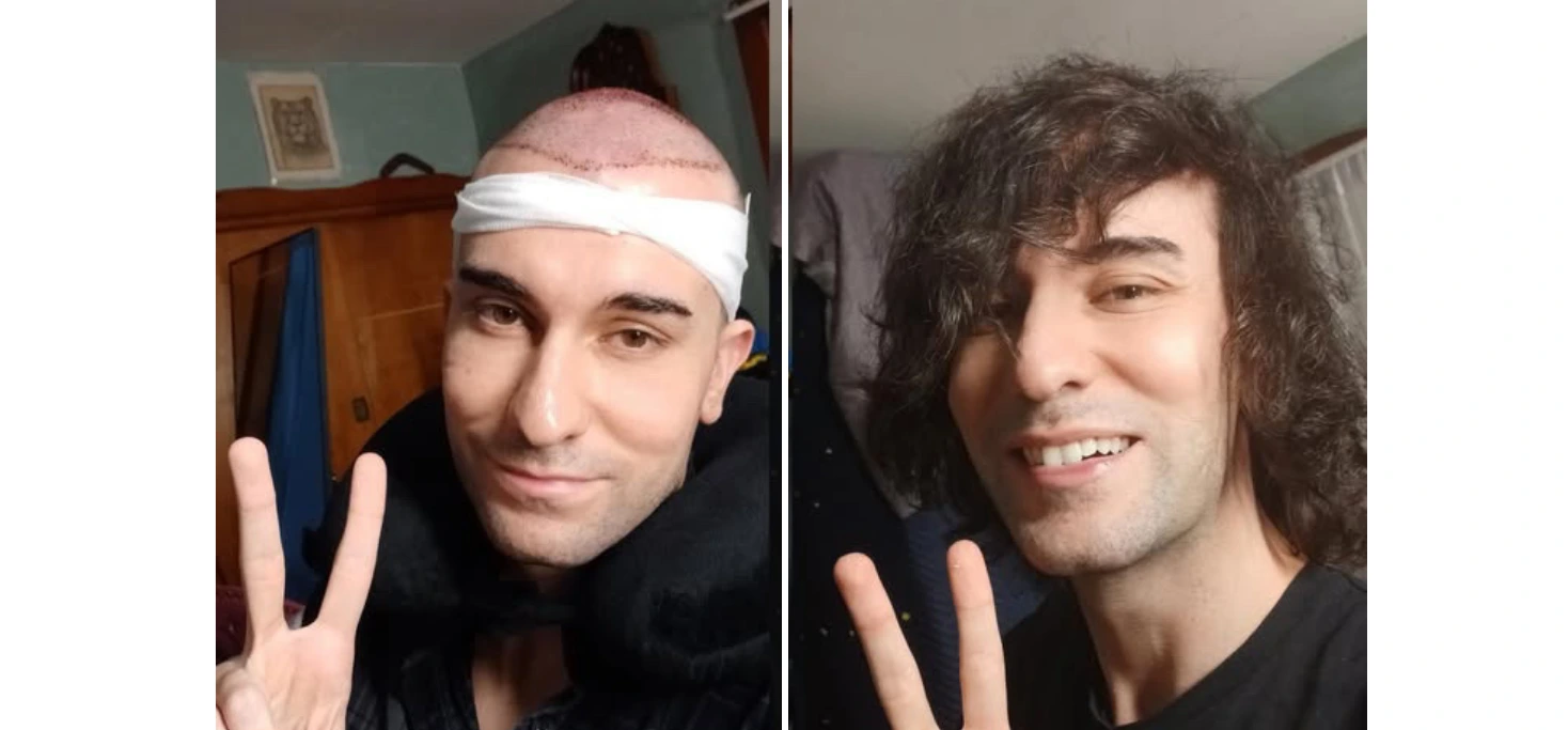 Two men displaying thick full hair after Regeneris hair restoration treatment