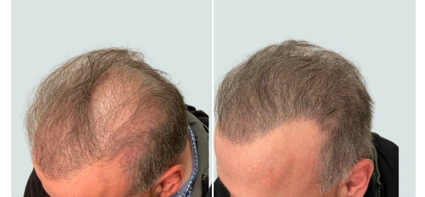 Before and after Regeneris hair treatment showing increased hair density on crown, side view