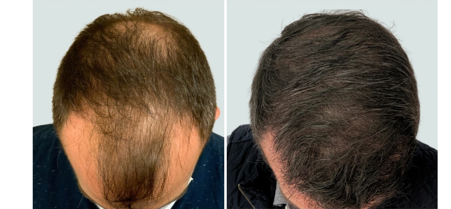 Before and after comparison of hair restoration on back of head, showing thinning hair progressing to fuller coverage