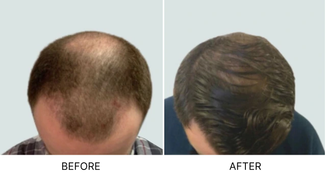 What Is Long Hair FUE? Banner