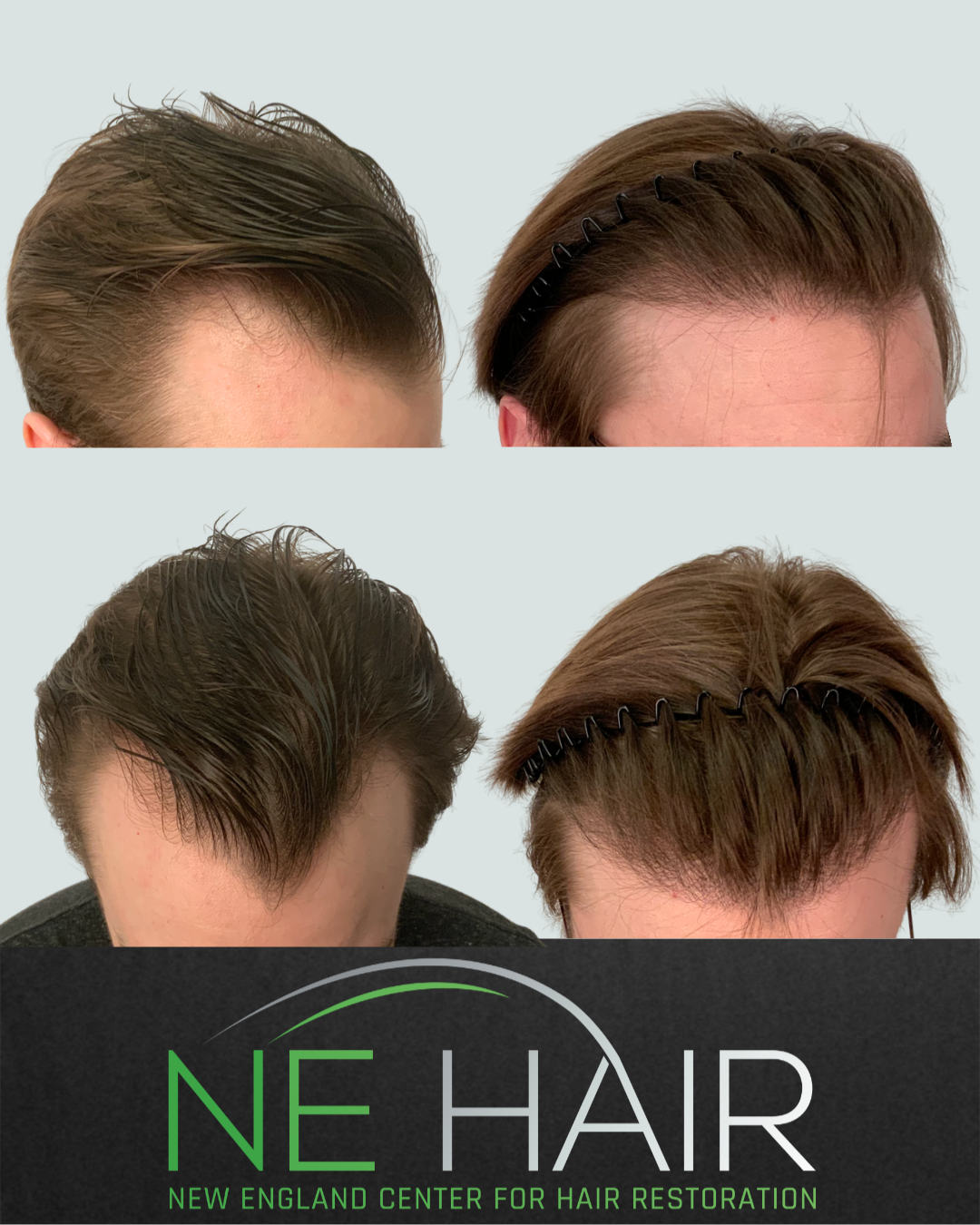 4.7 - hair transplant
