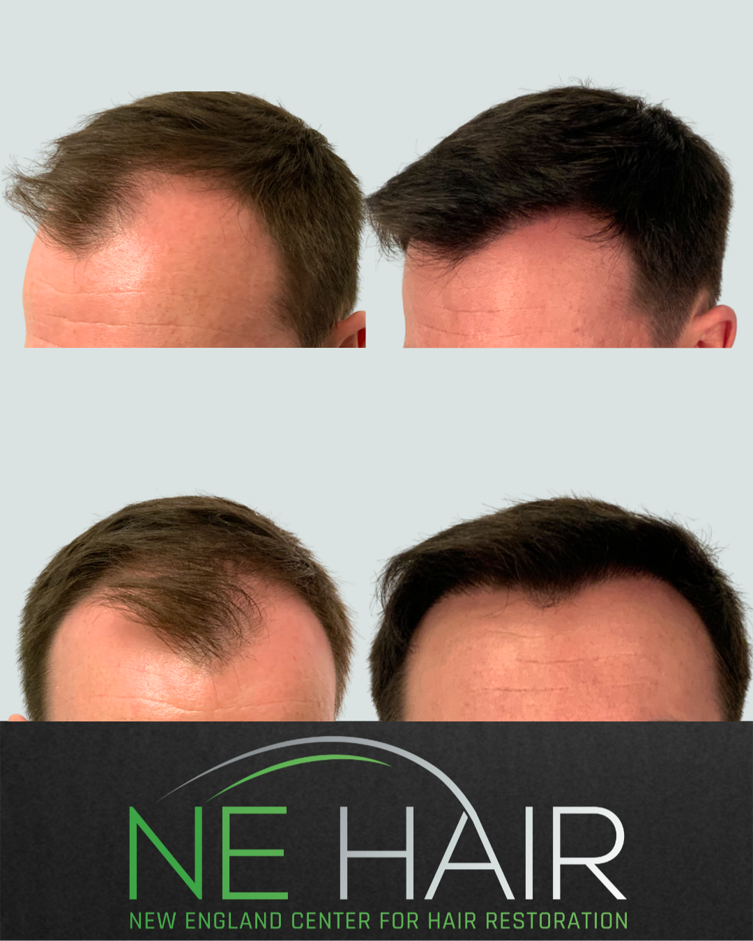 4.8 hair transplant