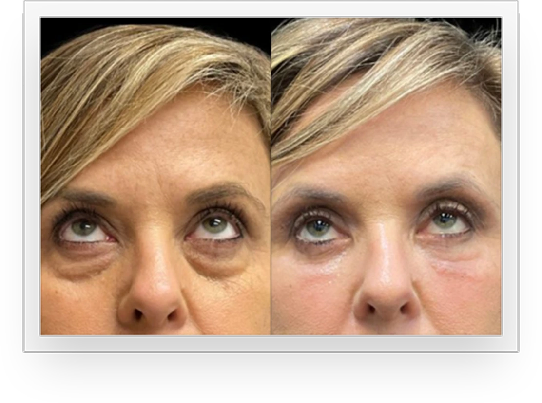 EyesBA1@1,5x