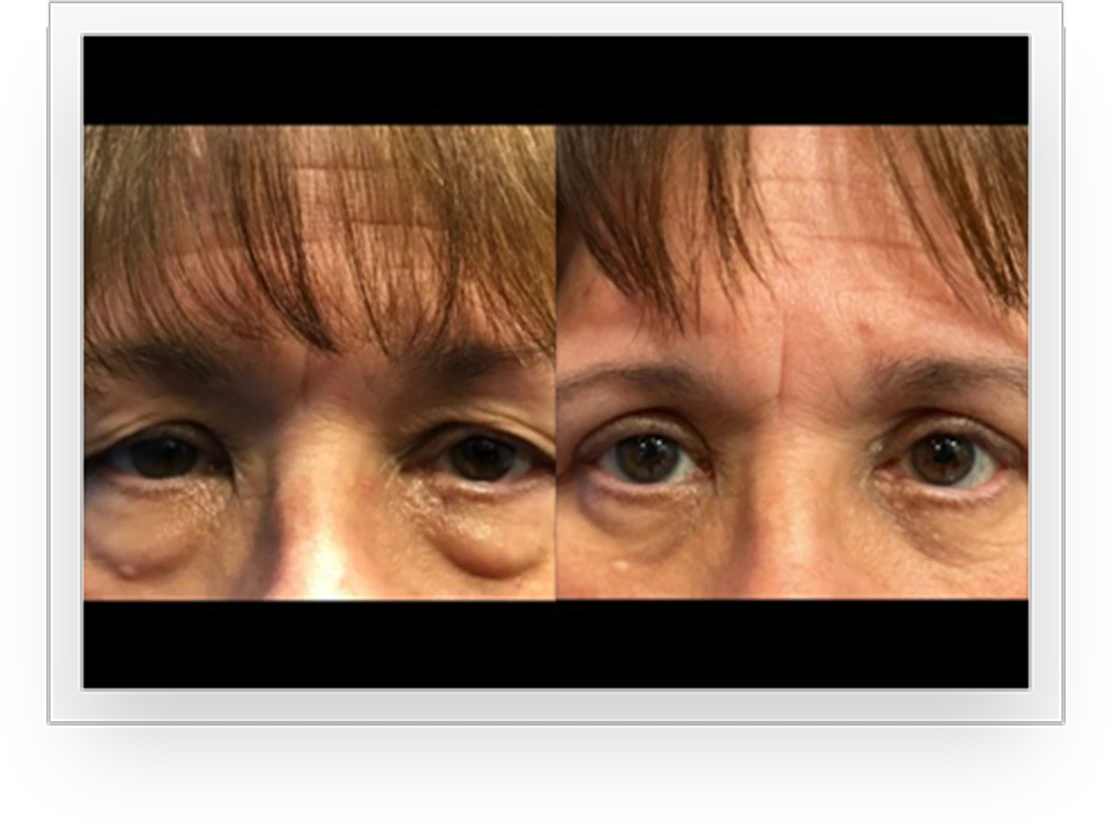 EyesBA2@1,5x