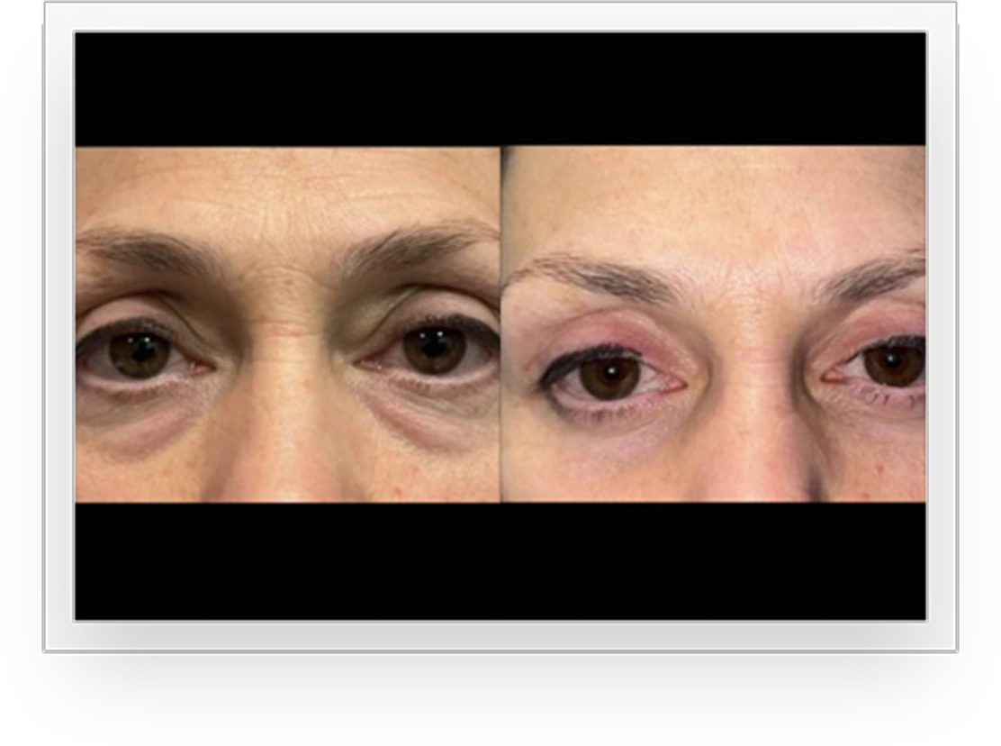 EyesBA3@1,5x