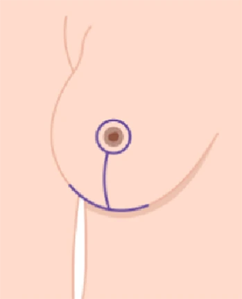 Diagram showing anchor-lift incision pattern on breast with vertical and horizontal marks