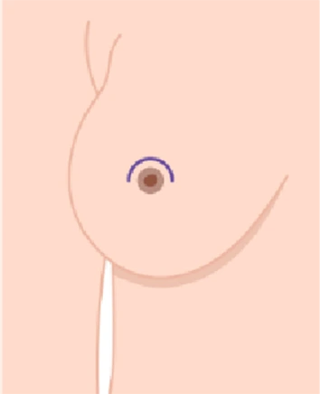 Diagram showing crescent-lift incision pattern on breast with marking above nipple
