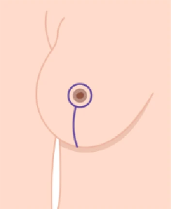 Diagram of lollipop lift breast surgery incision pattern with blue line