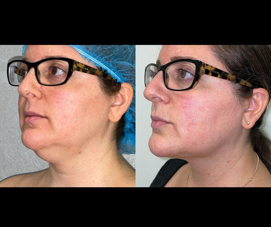 Lipo-Results-Dr
