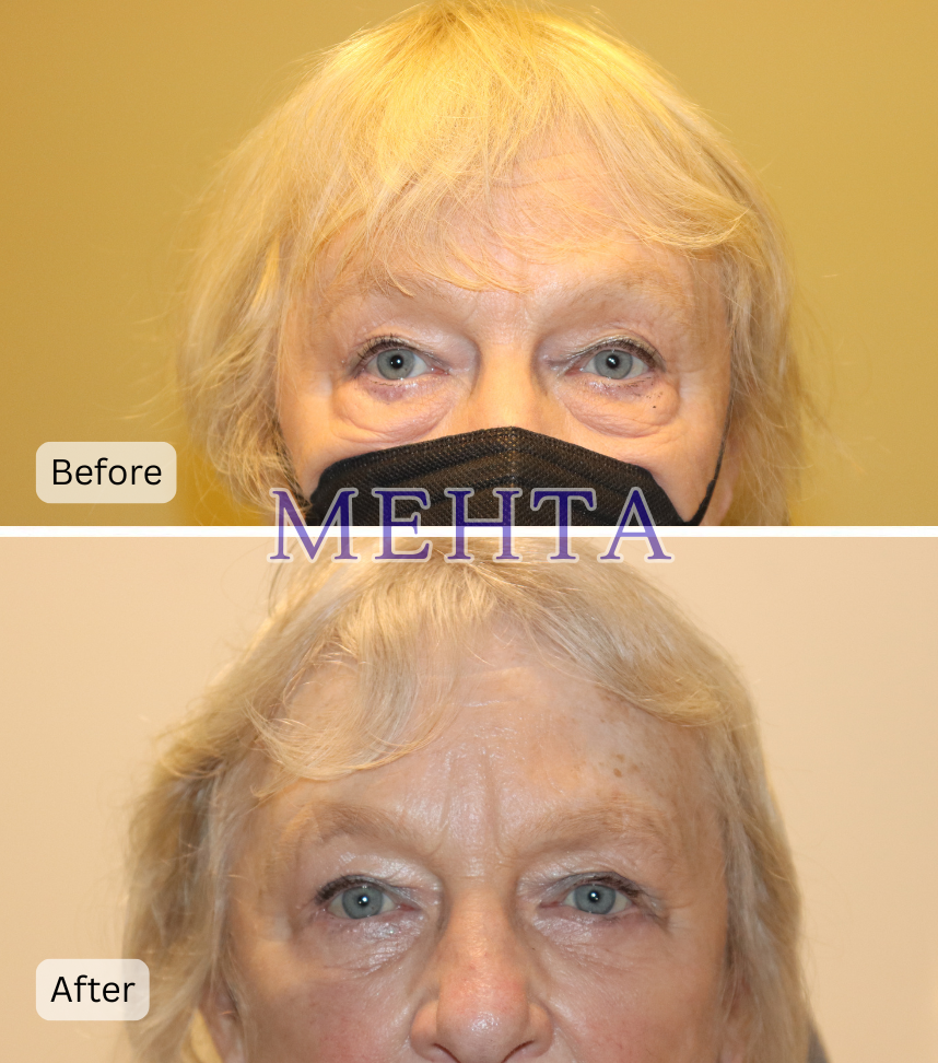 Before and after bilateral lower eyelid blepharoplasty showing reduced under-eye puffiness and bags