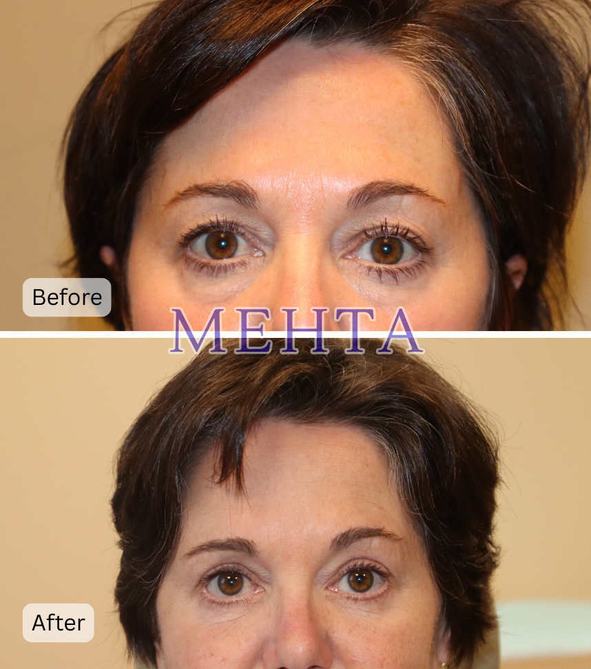 Before and after bilateral upper and lower eyelid blepharoplasty with improved eyelid definition and reduced heaviness