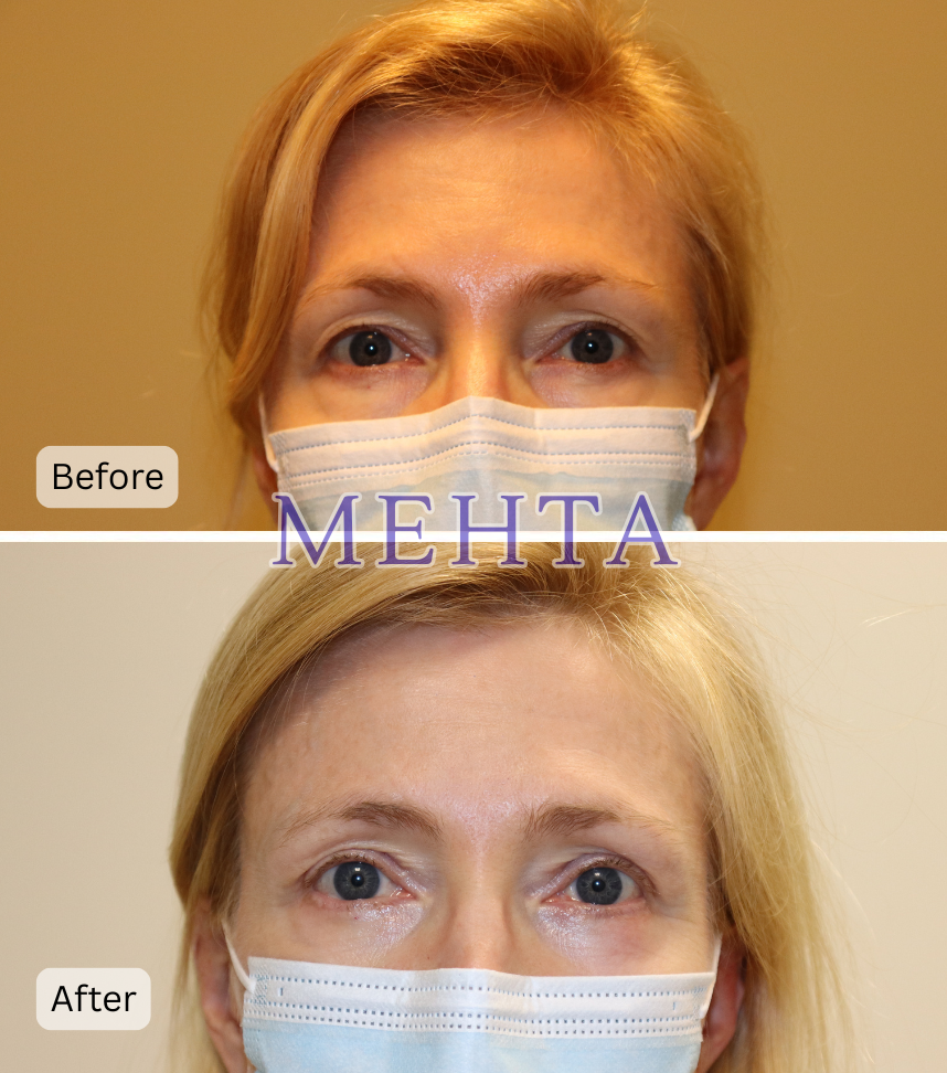 Before and after bilateral upper and lower eyelid blepharoplasty showing lifted eyelids and reduced lower lid sagging