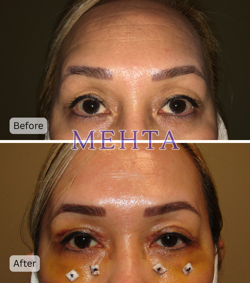 Before and after bilateral upper and lower eyelid blepharoplasty with improved eyelid contour and reduced under-eye bags