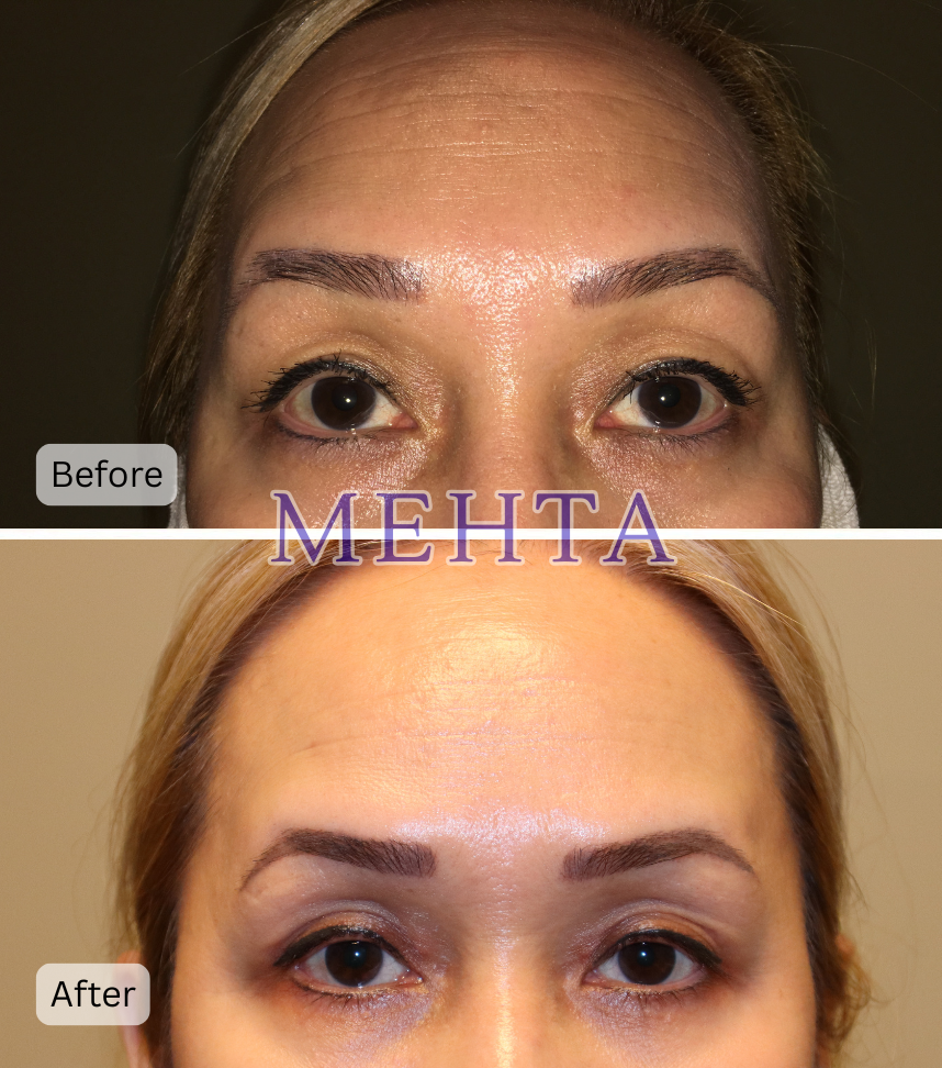 Before and after bilateral upper and lower eyelid blepharoplasty with reduced puffiness and wrinkles