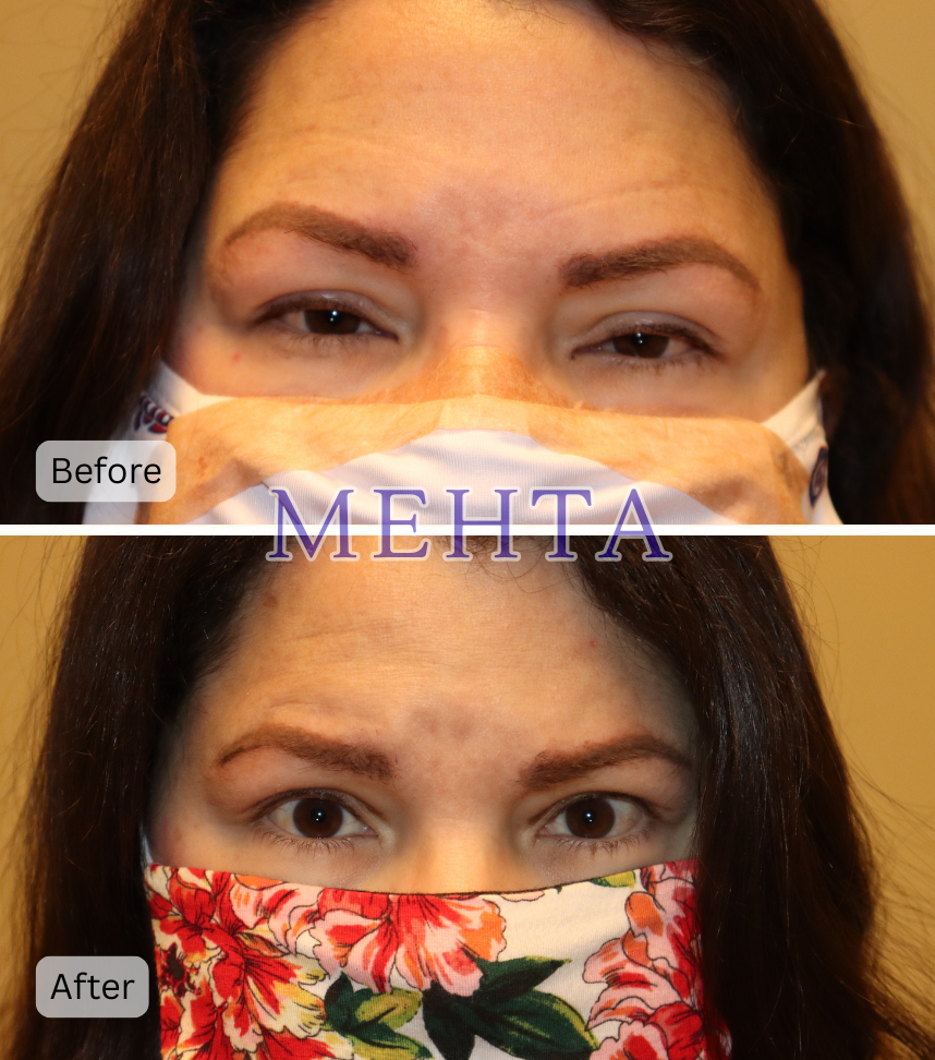 Before and after bilateral upper eyelid blepharoplasty and ptosis repair; before shows mild ptosis and upper lid heaviness, after shows improved definition and eye opening