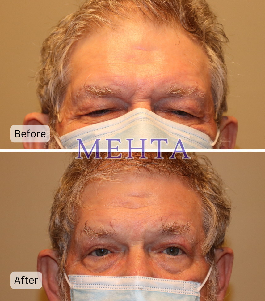Before and after bilateral upper eyelid blepharoplasty and ptosis repair; before shows significant ptosis and excess upper lid skin, after shows elevated and refined lids