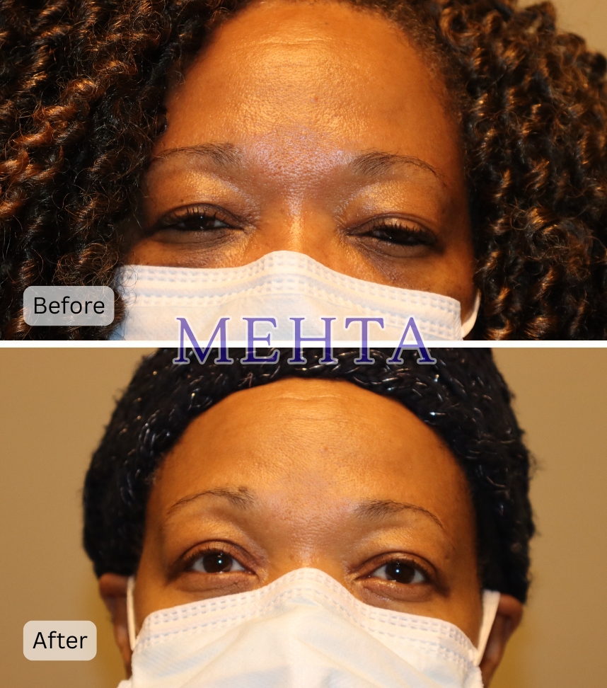 Before and after bilateral upper eyelid blepharoplasty and ptosis repair; before shows heavy hooded lids, after shows more open eyes with reduced upper lid fullness