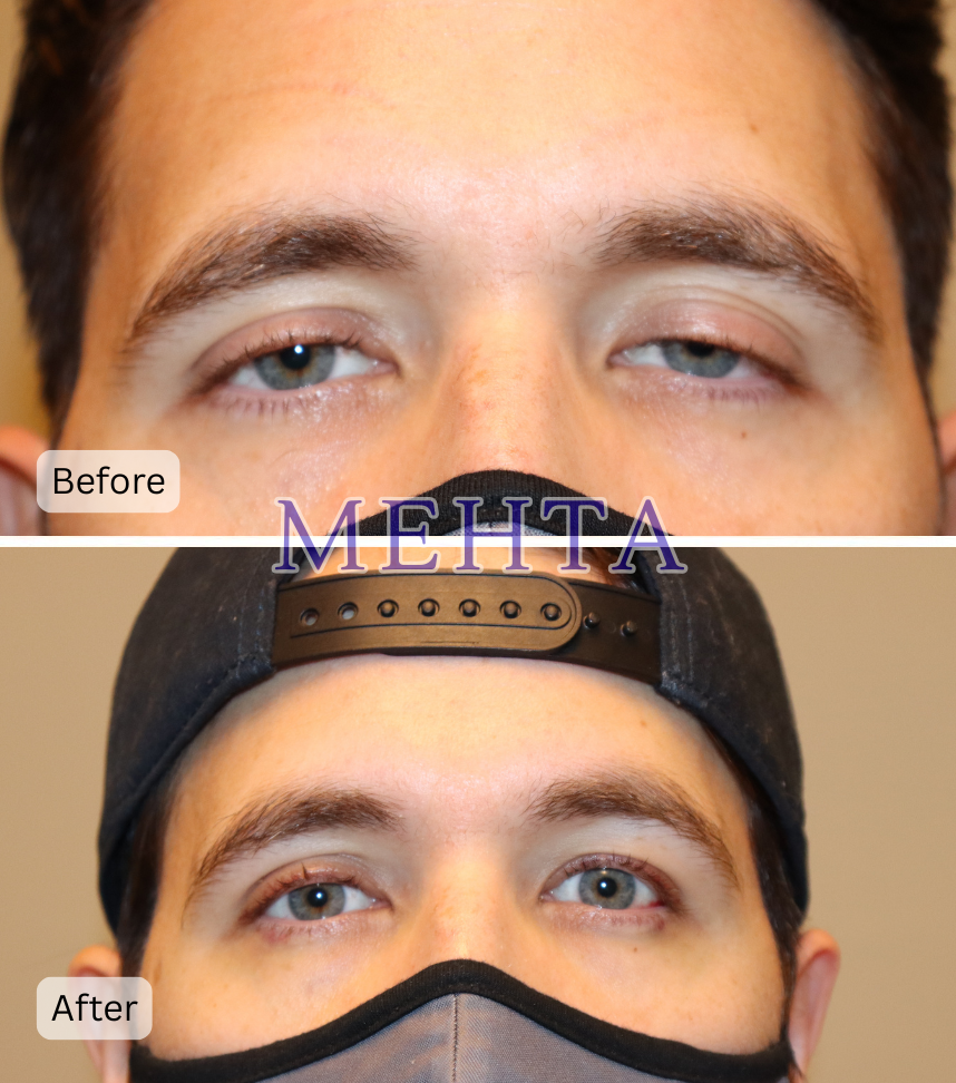 Before and after bilateral upper eyelid ptosis repair; before shows mild drooping of both upper lids, after shows improved lid height and symmetry