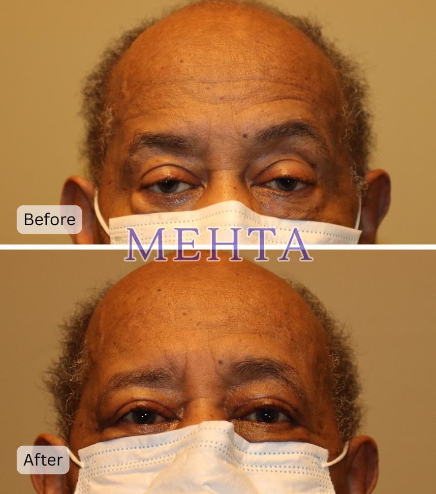 Before and after bilateral upper eyelid ptosis repair; before shows significant ptosis with heavy lids, after shows improved eyelid elevation