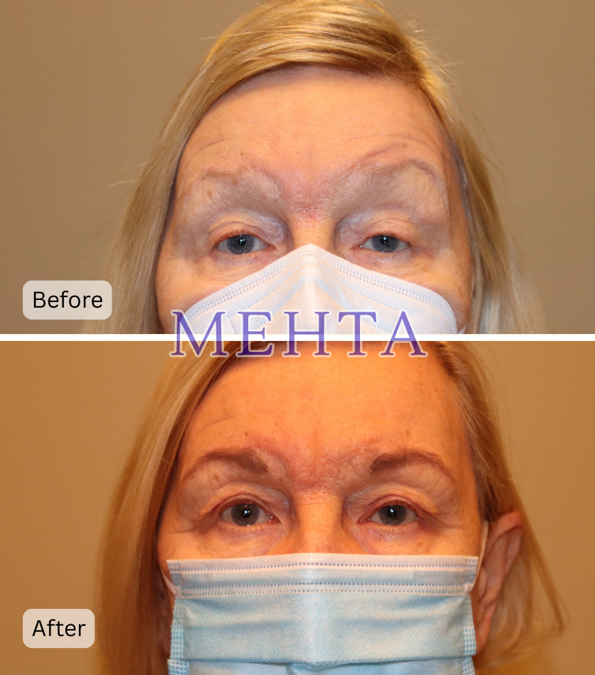 Before and after bilateral upper eyelid ptosis repair; before shows drooping upper lids, after shows lifted and more open eyes