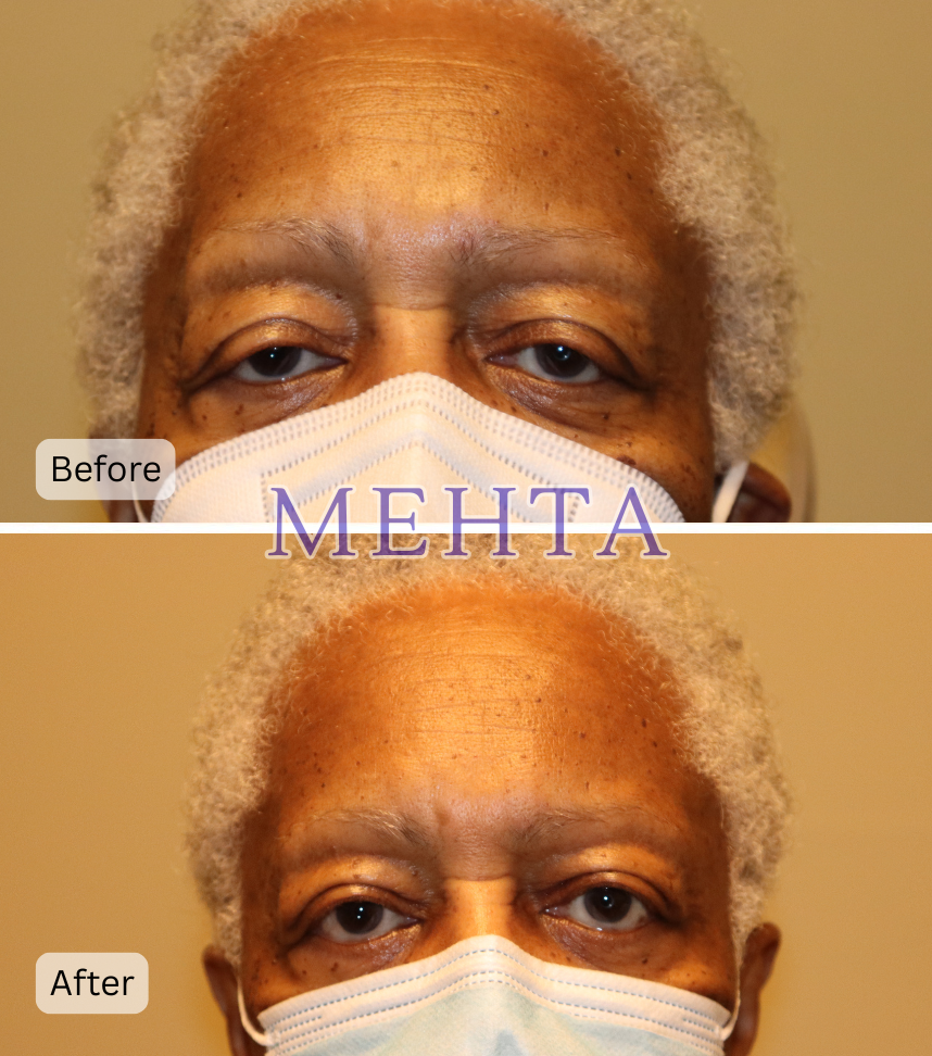 Before and after bilateral upper eyelid ptosis repair showing improved eyelid elevation and opening