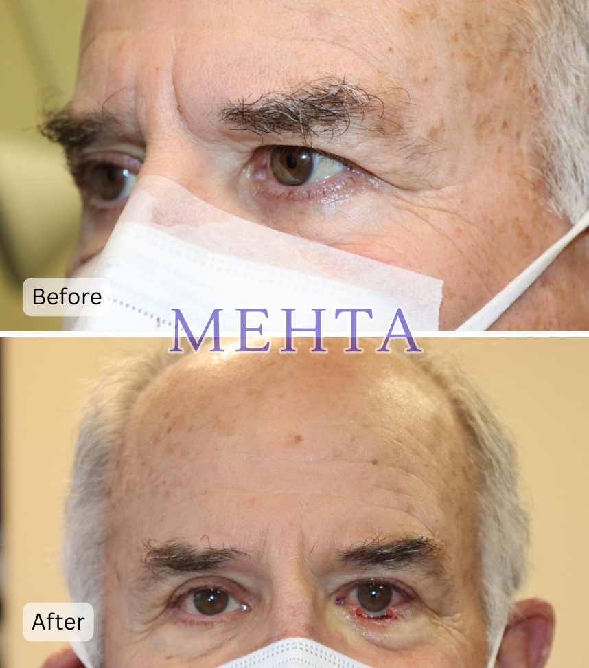 Before and after eyelid cancer reconstruction with close-up view of eyelid contour restoration