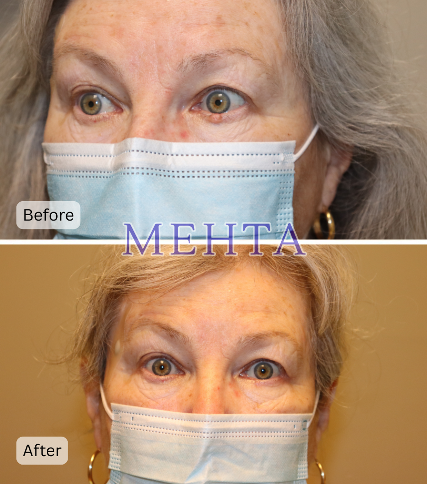 Before and after eyelid cancer reconstruction showing restored eyelid appearance and function