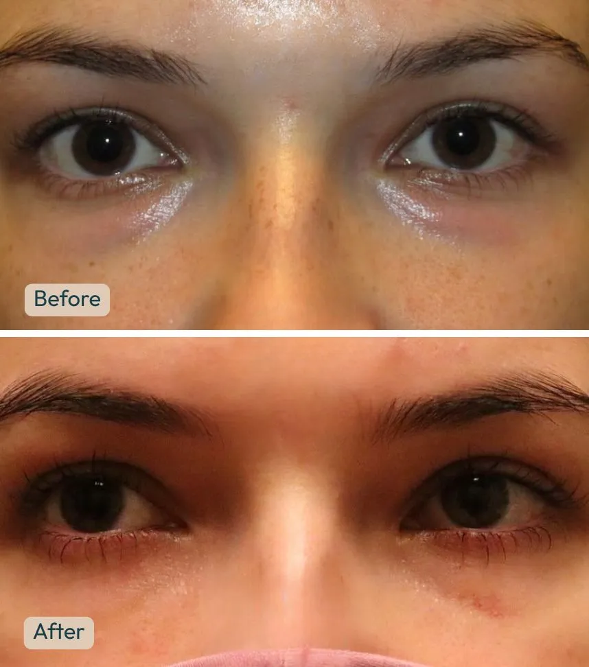 Before and after lower blepharoplasty showing improved under-eye bags and smoother lower eyelid appearance