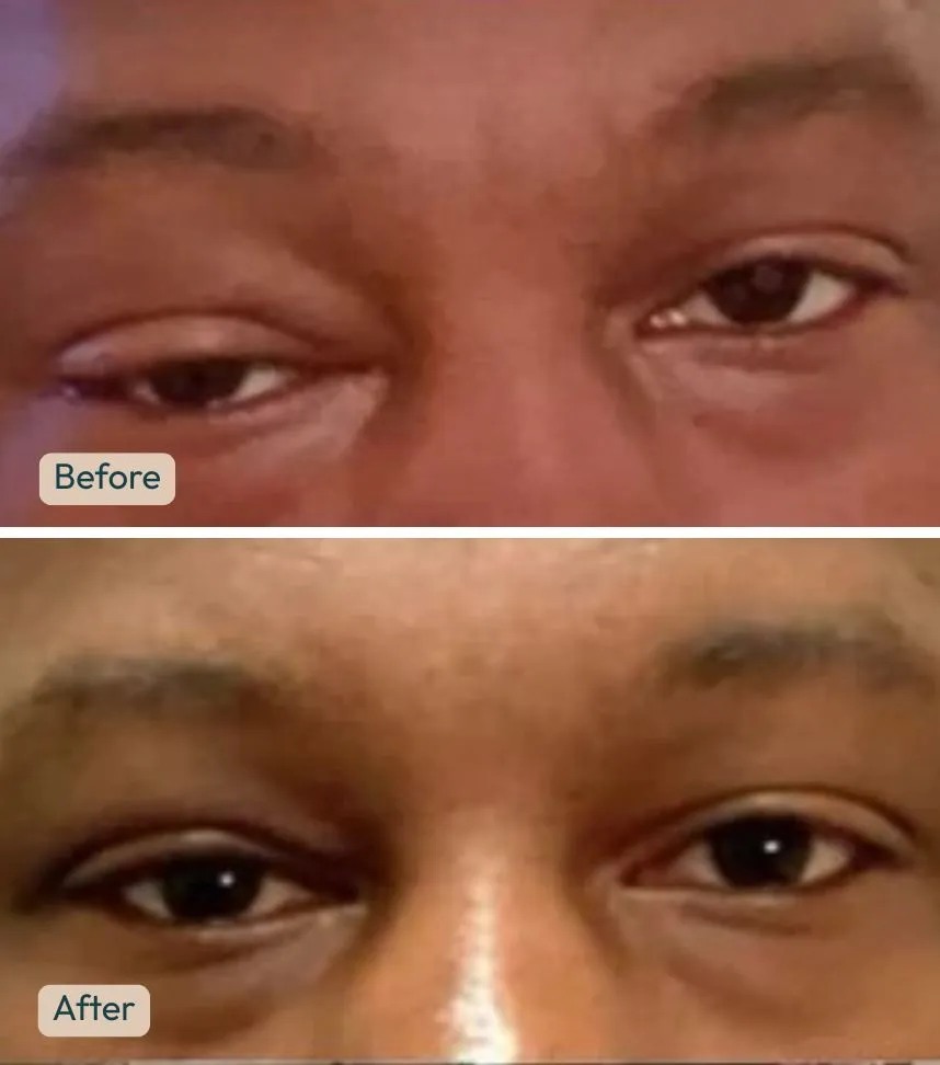 Before and after lower eyelid blepharoplasty demonstrating improved lower eyelid contour and reduced swelling