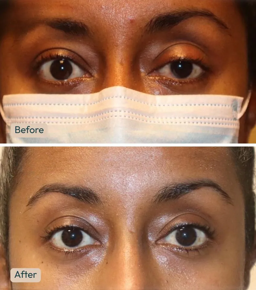 Before and after scarless ptosis repair showing raised upper eyelid and improved eye symmetry