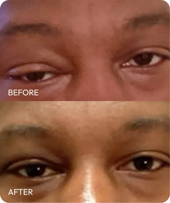 Before and after solitary fibrous tumor removal showing reduced swelling around both eyes