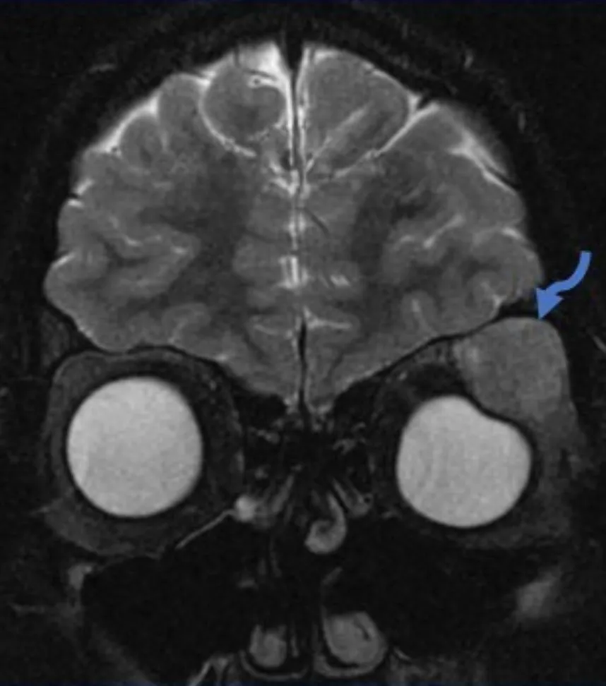 Brain MRI coronal view with blue arrow indicating tumor location in orbital region