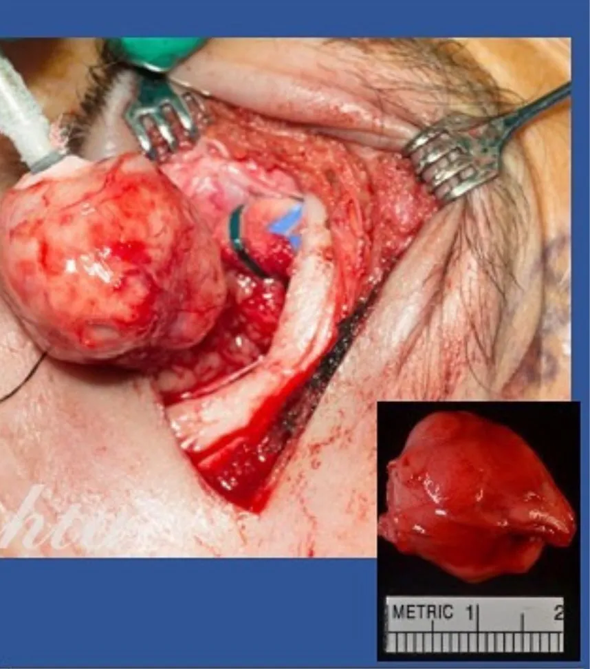 Surgical removal of orbital tumor with inset showing excised tissue specimen against metric scale