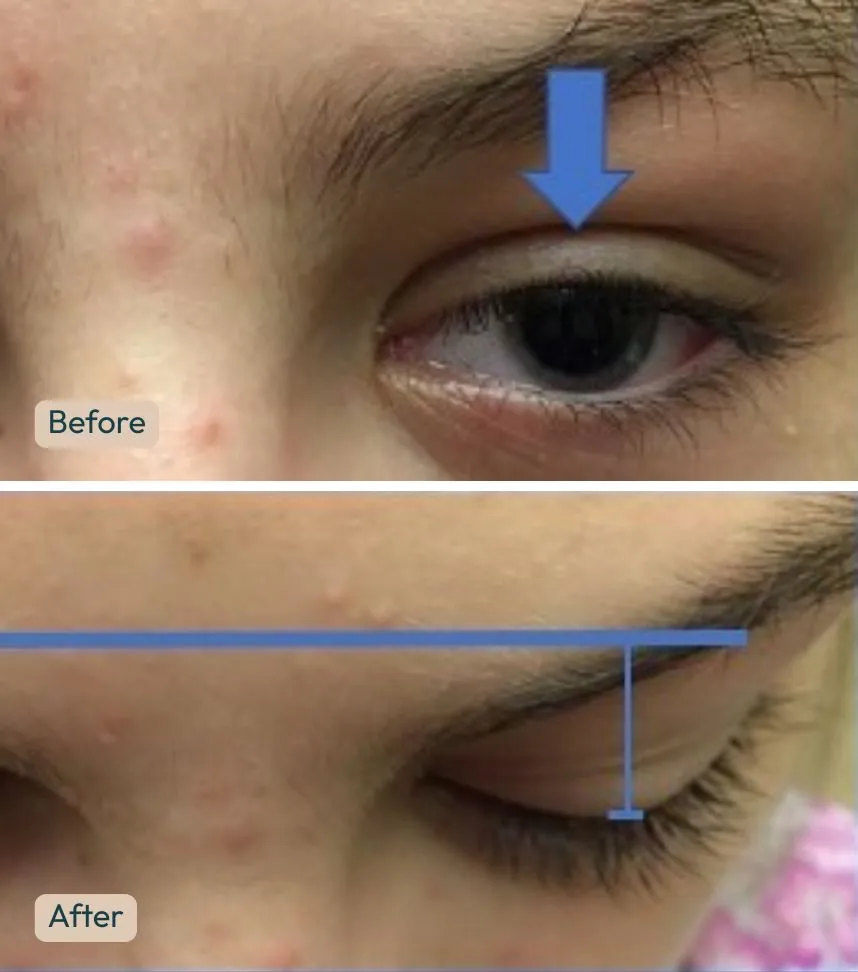 Before and after tumor removal showing reduced upper eyelid mass and improved eyelid contour