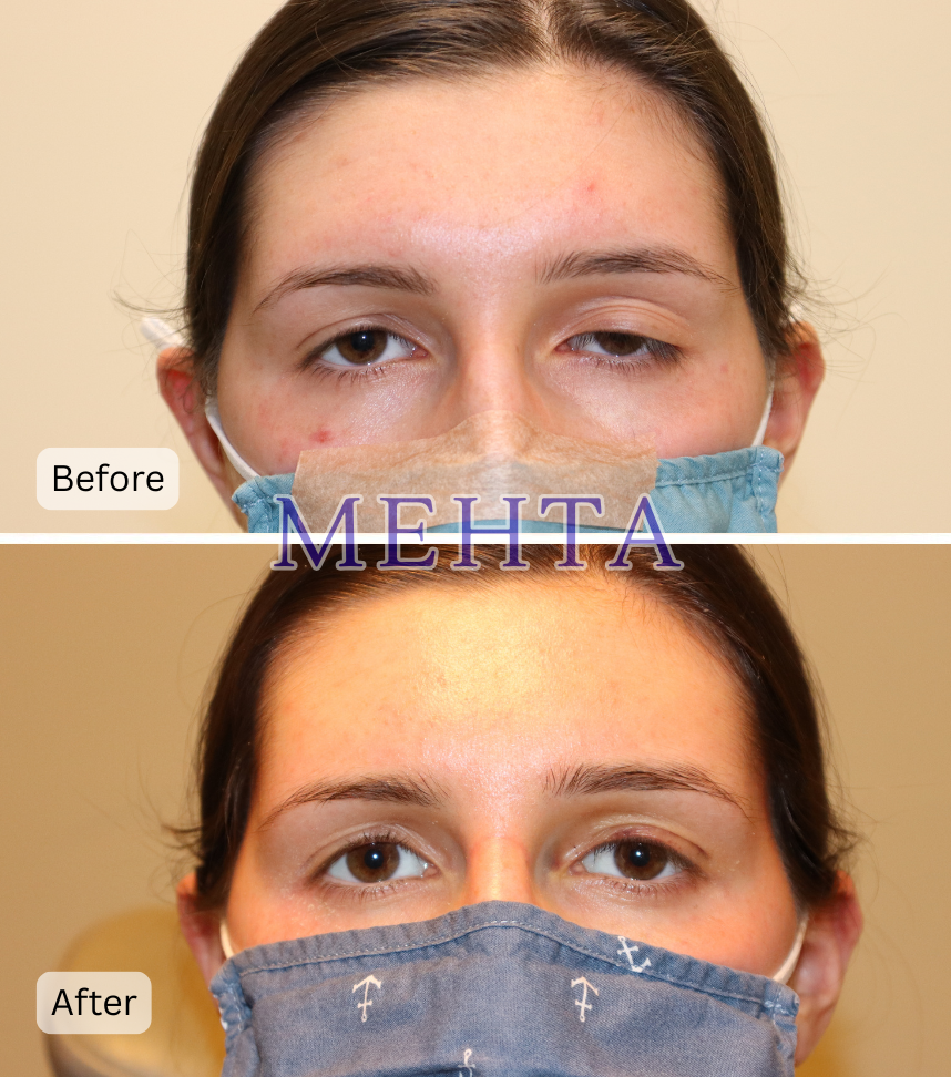 Before and after unilateral upper eyelid ptosis repair demonstrating corrected drooping eyelid
