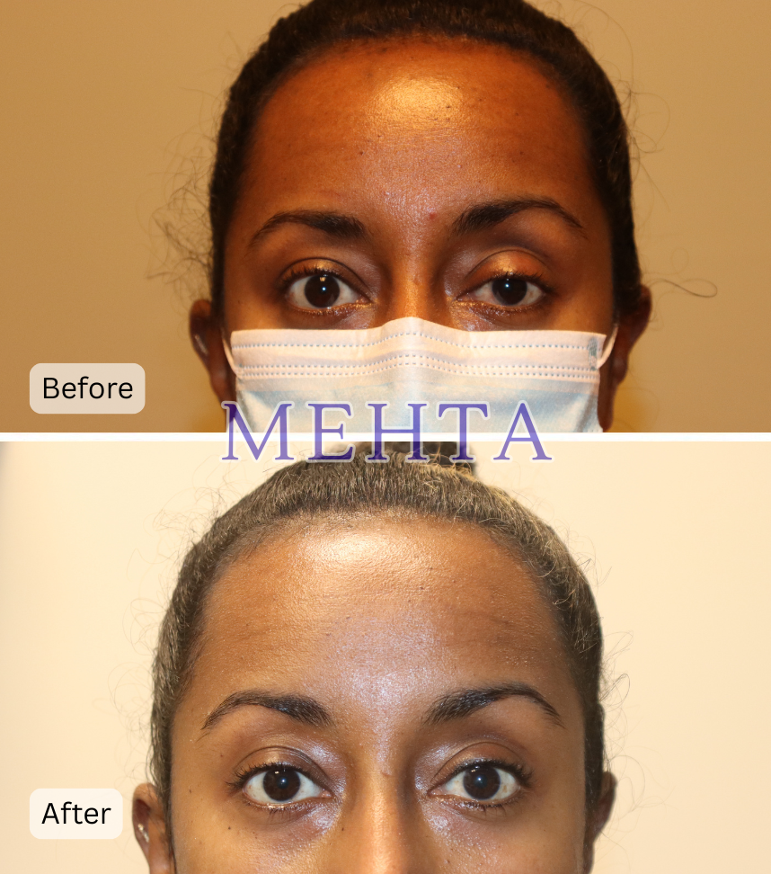 Before and after unilateral upper eyelid ptosis repair showing improved eyelid elevation and symmetry