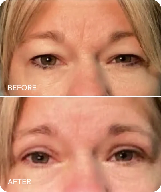 Before and after upper blepharoplasty showing improved eyelid contour and reduced drooping
