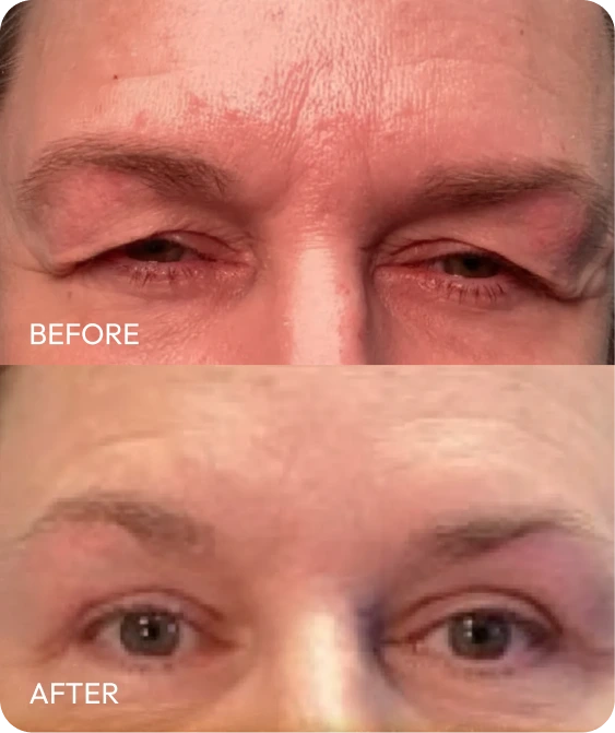 Before and after upper blepharoplasty showing lifted eyelids and reduced excess skin