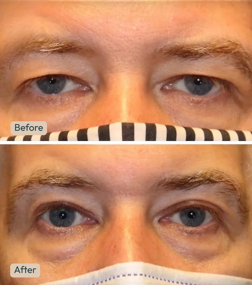 Before and after upper blepharoplasty with internal brow lift showing reduced upper eyelid drooping and lifted brow position