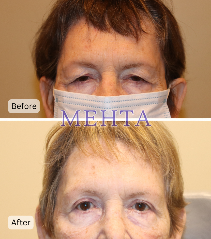 Before and after upper eyelid blepharoplasty showing reduced drooping and improved eyelid appearance